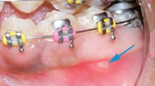inflamed gums due to braces