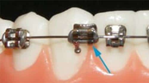 find out how to fix a loose bracket