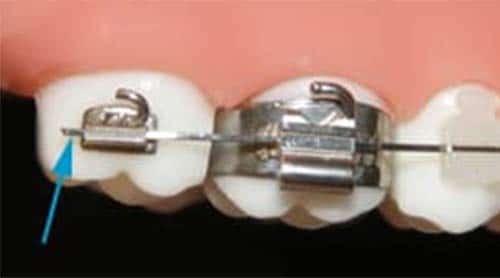learn how to fix a poky wire on your braces