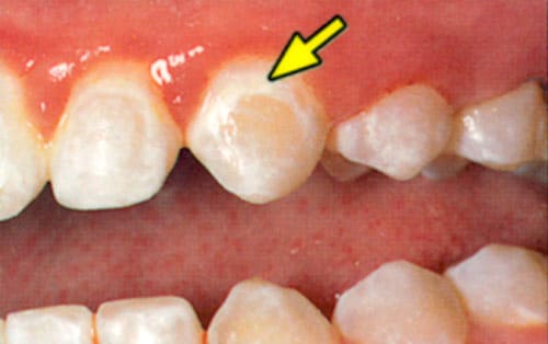 decalcification caused by poor brushing