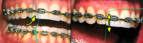 how to brush and floss with braces